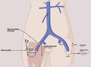 “U” tunnel for the tunneled femoral catheter: subcutaneous trajectory, key anatomic points and suggested measures.