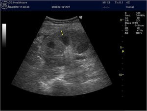 Low-frequency convex probe (3.5–5 mHz) placed between the medial axillary line and the posterior axillary line. Longitudinal plane of the left kidney. Dotted line: Cortical thickness (from the base of the renal pyramid to the renal capsule).