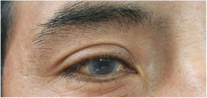 Opacity of the peripheral corneal stroma.