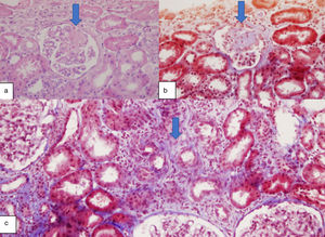 Kidney biopsy showing (a) glomerular segmental sclerosis, H&E 400×; (b) glomerular segmental sclerosis, Trichrome stain 400×; (c) interstitial fibrosis, Trichrome stain 200× by light microscopy.