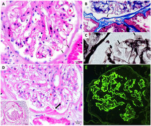 The kidney biopsy findings. (A) Glomerulus demonstrating thickened capillary walls (H&E). (B) Fucsinophilic deposits barely seen on capillary walls (MTC stain). (C) Scarce glomerular wall vacuolization (JMS stain). (D) Diabetic changes; hyaline droplets on Bowman capsule (arrow; H&E) and capsule duplication (PAS stain; inset). (E) Immunoflorescence microscopy showing diffuse fine granular IgG deposition along the glomerular capillary wall.