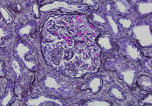 Methenamine silver stain. Segmental sclerotic lesion within a glomerulus.