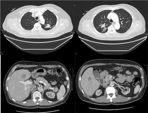 Images visualized on thoraco-abdomino-pelvic CT scan.