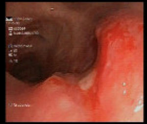 Tracheal ulcer visualized on fiberoptic bronchoscopy.
