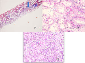 Allograft biopsy shows interstitial fibrosis, tubular atrophy and an area of inflammation (thick arrow) by light microscopy, masson trichrom ×40 (A), the presence of desquamation and necrosis in the tubule epithelium is shown (thin arrow) PAS ×400 (B), Hodgkin cells in the lymphoid background are indicated by arrows, H&E ×400 (C).