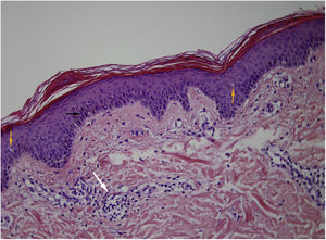A) Black arrow: parakeratosis. B) Orange arrow: spongiosis. C) White arrow: focal lymphocytic exocytosis on the dermis with superficial perivascular lymphocytic infiltrate.