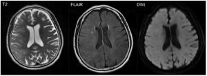 Magnetic resonance imaging (MRI) of an 84-year-old woman with left hemiplegia and right gaze deviation with loss of consciousness after cardiac catheterization. MRI two hours after the procedure shows effacement of sulci at the right parieto-occipital level with respect to the contralateral with cortico-subcortical hyperintensity at that level in T2 and FLAIR, suggestive of cerebral edema and absence of ischemic lesions in DWI. Meng-Ru et al.19 With permission of the authors.