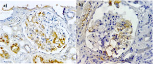 Immunoperoxidase staining with anti-C4d antibodies in patients with FSGS. (a) Segmental positive with moderate intensity in the mesangium and endothelial cells of the glomerular capillaries with a uniform granular distribution. Non-specific deposits in the cytoplasm of the tubules. (b) Segmental positive with moderate intensity in the mesangium and endothelial cells of the glomerular capillaries, also C4d without expression in the endothelium of the peritubular capillaries. Images ×40.