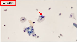 Urine cytology shows atypical cells with hyperchromatic nuclei and scant cytoplasm (red arrow) compared to adjacent normal urothelial cells.