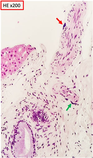 The liver biopsy shows, at the level of the portal space, cells of karyomegalic habitus, some in perineural (red arrow) and perivascular (green arrow) arrangement showing large, irregular and hyperchromatic nuclei.