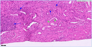 Foci of inflammatory infiltrate are observed in the cortex, forming patches and also arranged in a dispersed manner. It is mainly composed of lymphocytes (blue arrows). Focally, the infiltrate affects the tubules (tubulitis) (green arrows). Hematoxylin-eosin ×20. The color of the figures can only be seen in the electronic version of the article.