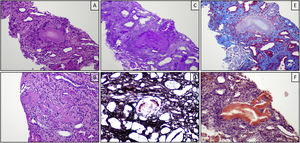 Renal biopsy, optical microscopy: histologically, intratubular eosinophilic casts are observed (A), which are focally associated with inflammatory response (B). The casts are weakly positive with the PAS technique (C), negative with silver (D) and polychromatophilic with Masson