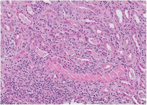 The interstitium shows a prominent polymorphous inflammatory infiltrate consisting of abundant polymorphonuclear leucocytes, lymphocytes, plasma cells and occasional eosinophils with images of tubulitis. Renal parenchyma with morphological data consistent with acute interstitial nephropathy and acute tubular necrosis with regenerative changes. PAS (periodic acid-schiff) stain, ×400.