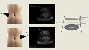 Ultrasound measurement of right and left para-perirenal fat thickness. Longitudinal kidney ultrasound shows the distance between the abdominal wall musculature and the kidney surface (yellow arrow). The ultrasound diagram is shown on the right. Authors’ own image.