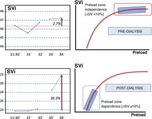 Frank-Starling law. The increase in stroke volume of a study subject after the infusion of 250 cc of volume (online fluid) in a pre- and post-dialysis is presented as an example.