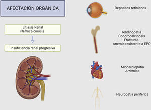 Clinical presentation and systemic involvement of hyperoxaluria. Created by Biorender.com. EPO: erythropoietin.