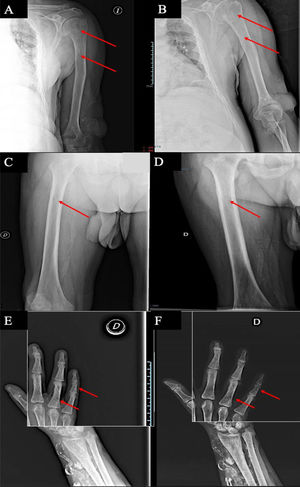 Radiological findings with radiolucent lesions before and after therapy in left humerus before (A) and after (B), right femur before (C) and after (D) and middle phalanx of V finger right hand, before (E) and after (F).