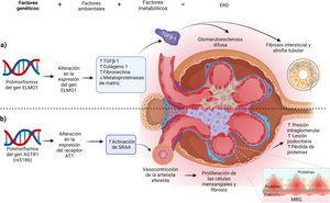 Created in BioRender.com. Mechanisms of action of ELMO1 and AGTR genes in the genesis of DKD. (a) Mechanism of ELMO1 gene polymorphisms. ELMO1 polymorphisms alter ELMO1 gene expression and favor the development of interstitial fibrosis, tubular atrophy and diffuse glomerulosclerosis through increased expression of profibrotic genes and inhibition of antifibrotic genes. (b) Mechanism of the rs5186 polymorphism of the AGTR1 gene. This polymorphism favors the instability in the transcription of the AGTR1 gene favoring the altered expression of the AT1 receptor, which causes a persistent activation of the RAAS, characterized by an increase in intraglomerular pressure and the ingury and loss of podocytes, damaging the architecture of the GBM favoring proteinuria. GBM, glomerular basement membrane; TGFβ-1, transforming growth factor beta 1; RAAS, renin angiotensin aldosterone system.