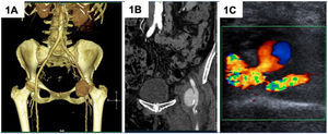 A-B)Caso 1. La angioTAC muestra a nivel de la arteria femoral común izquierda un gran PAF de 5,3cm de diámetro máximo que presenta comunicación con la arteria sin cuello. C)Caso 2. El doppler arterial muestra una pequeña colección de 1,5cm de diámetro medial a la arteria femoral común distal derecha; presenta relleno con flujo arterial en vaivén y tiene cuello corto.