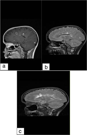 Multiple bilateral periventricular supratentorial lesions and sub cortical white matter hyper signal foci in T1 with gadolinium (1.a), FLAIR (1.b) and Dawson's fingers (1.c).
