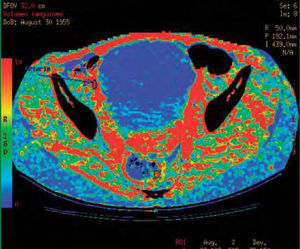 Resultados de una ROI dibujada en una arteria (1) y en la lesión tumoral (3) sobre el mapa funcional de volumen sanguíneo en un estudio de perfusión de recto.
