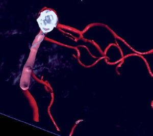 Reconstrucción 3D con corte transversal del tronco basilar con visión del stent y los coils que embolizan el aneurisma.