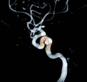 Simulación de la colocación de un stent en el cuello del aneurisma en la carótida interna.