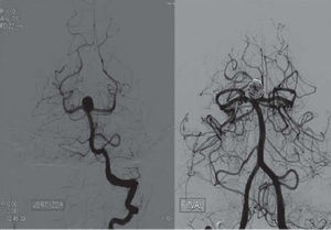 Imágenes angiográficas con sustracción digital en proyección posteroanterior, de un aneurisma sobre tronco basilar, en situación de preembolización y postembolización.