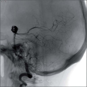 Imagen angiográfica directa en proyección LAT del aneurisma embolizado, mediante stent y coils.