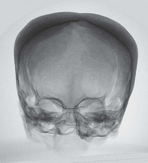 Radiografía anteroposterior del cráneo.