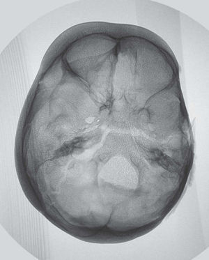 Radiografía axial del cráneo.