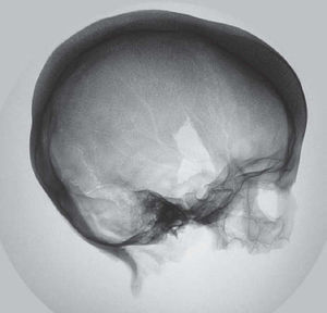 Radiografía lateral del cráneo.