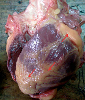 Corazón de un paciente masculino de 58 años, obeso, diabético e hipertenso. Nótese (señalado con flechas) el gran espesor y la distribución del tejido adiposo epicárdico.