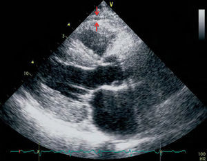 Medición ecocardiográfica del espesor de la grasa epicárdica en un eje largo paraesternal. La grasa epicárdica se identifica como el espacio (entre flechas) entre la pared externa del miocardio y la capa visceral del pericardio.
