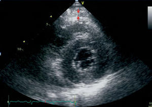 Medición ecocardiográfica del espesor de la grasa epicárdica en un eje corto paraesternal. La grasa epicárdica se identifica como el espacio (entre flechas) entre la pared externa del miocardio y la capa visceral del pericardio.