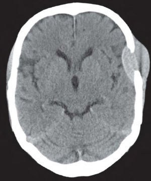 Imagen de tomografía computarizada en la que se observa lesión intracraneal frontotemporal izquierda.