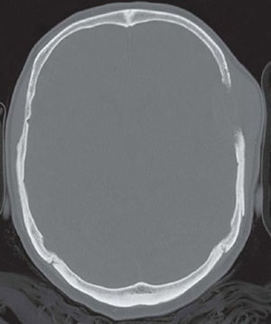 Imagen de tomografía computarizada con filtro de hueso en la que se observa imagen de destrucción ósea.