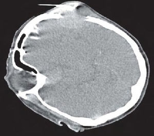 Imagen de tomografía computarizada fluoroscopia en la que se observa la aguja de biopsia entrando en la lesión.
