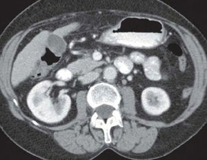 Imagen de nódulo hepático por tomografía computarizada.