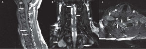 A) Imagen en plano sagital potenciada en T1SE donde se pude observar que los tumores tienen un crecimiento intracanal. B) Imagen en plano coronal obtenida con una secuencia TFE balanced, en la que se puede ver el crecimiento intracanal y el desplazamiento de la médula. C) Imagen transversal TFE balanced, en la que se observa la afectación de los nervios en los agujeros de conjunción.