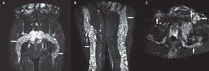 Imágenes obtenidas con secuencias T2 TSE con supresión grasa. A) Imagen en plano coronal de la pelvis, en la que se aprecia el crecimiento de tumores a lo largo del plexo sacro y todas sus ramas. B) Imagen en plano coronal de los muslos, del mismo paciente, pudiendo ver la extensión de la enfermedad. C) Imagen en plano transversal de la pelvis a nivel de la sínfisis, donde se pueden ver, además de la afectación de la cadena principal, otras lesiones, como la del nervio obturador.