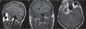 Imágenes compatibles con NF1. A) Plano sagital en el que se observa la tumoración cerebral siguiendo el trayecto del 5 par craneal. B) Plano coronal en el que se muestra una hipoplasia del ala esfenoidal. C) Imagen axial contrastada donde se pueden apreciar áreas quísticas.