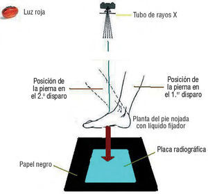 Método de obtención del radiofotopodograma.