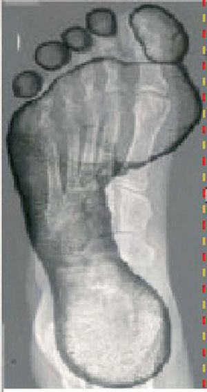 Radiofotopodograma normal del pie izquierdo.