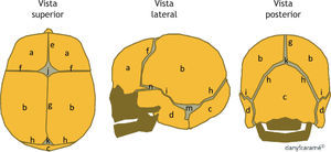 Esquema de un cráneo normal. a: hueso frontal; b: hueso parietal; c: hueso occipital; d: hueso temporal; e: sutura metópica; f: sutura coronal; g: sutura sagital; h: sutura lambdoidea; i: sutura temporo-parietal; j: fontanela anterior; k: fontanela posterior; m: fontanela mastoidea; n: fontanela esfenoidal.