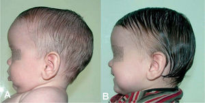 Paciente con escafocefalia. A. Cinco meses de edad, imagen preoperatoria. B. Imagen a los 9 meses poscirugía y con tratamiento de DOC-Band® durante 2 meses.