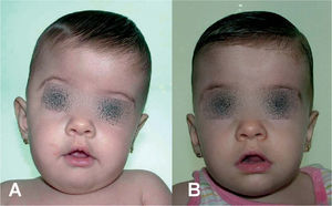 Paciente con plagiocefalia anterior derecha. A. Cinco meses de edad, imagen preoperatoria. B. Imagen a los 3 meses poscirugía endoscópica y tratamiento con DOC-Band®.