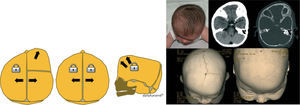Esquema e imágenes de la plagiocefalia anterior, consistente en el cierre temprano de la sutura coronal, y braquicefalia, por cierre temprano de las dos suturas coronales.