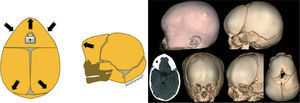 Esquema e imágenes de la trigonocefalia, consistente en el cierre temprano de la sutura metópica.