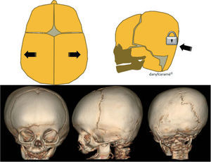Esquema e imágenes de la plagiocefalia posterior, consistente en el cierre temprano de la sutura lambdoidea.
